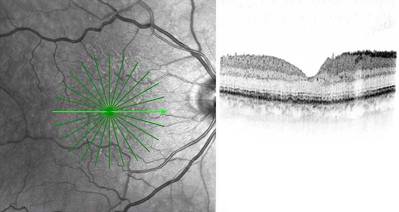 epiretinale-gliose-nach-op